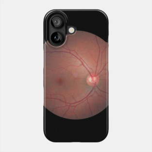 Eyebal X-ray Phone Case